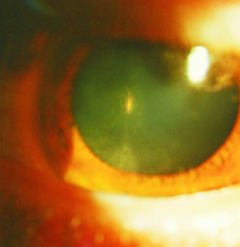 Cataract after can-c